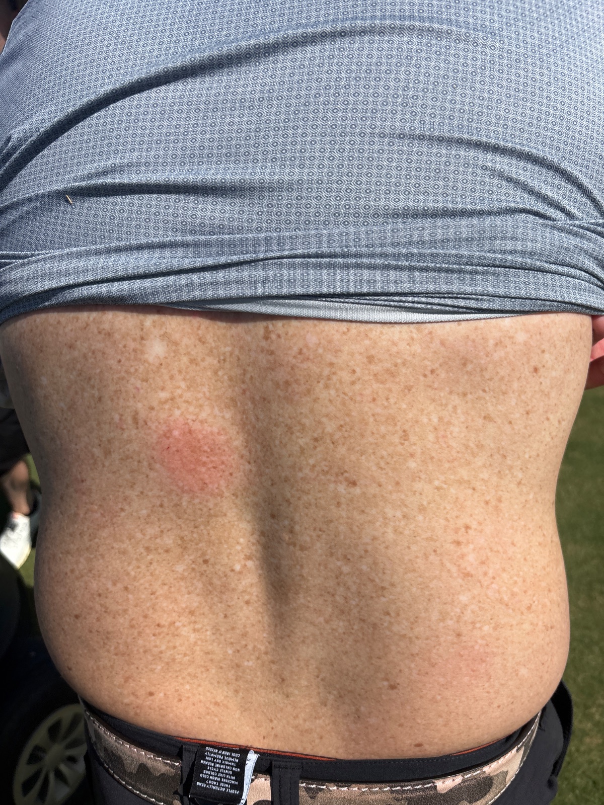 Exhibit B — the bruise, documented